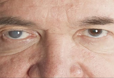 Phacoemulsification