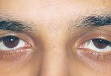 Laser treatment